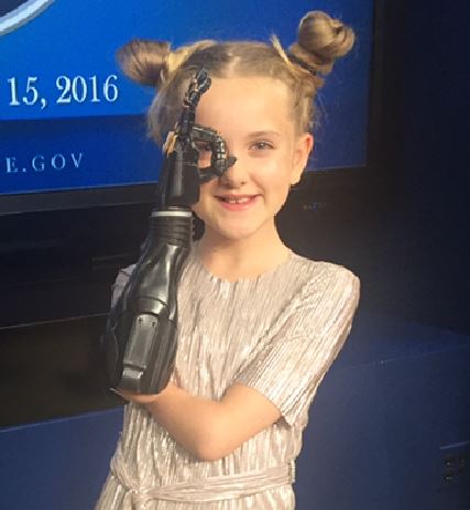 World first trial of 3D printed bionic hands