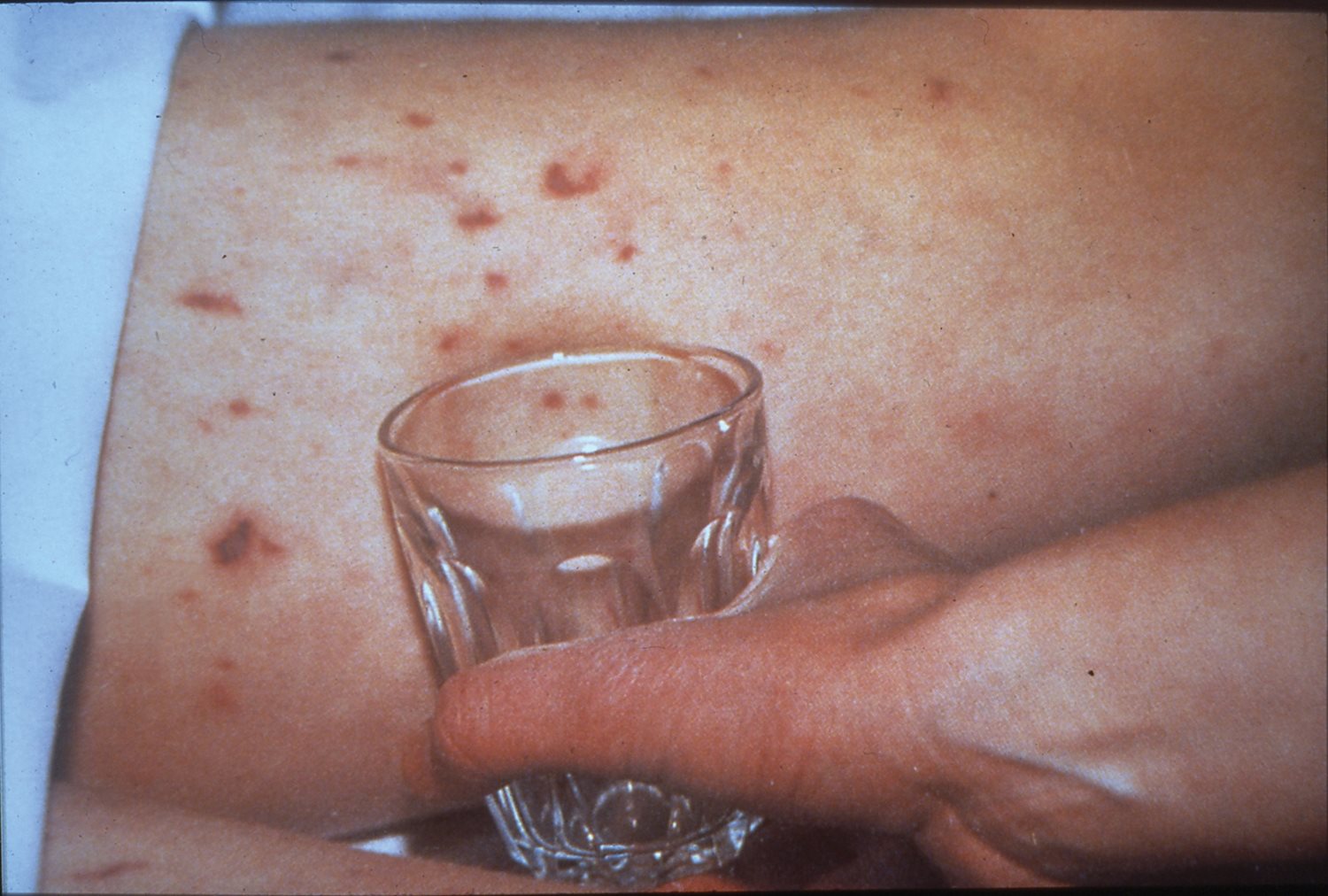 Meningitis rash close up