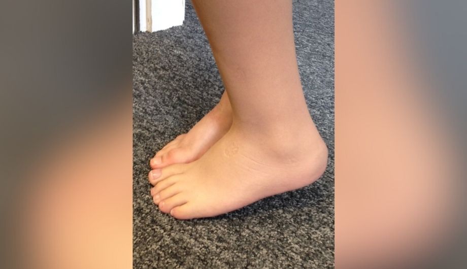 A close up image of Sofia's foot and her prosthetic leg and foot.