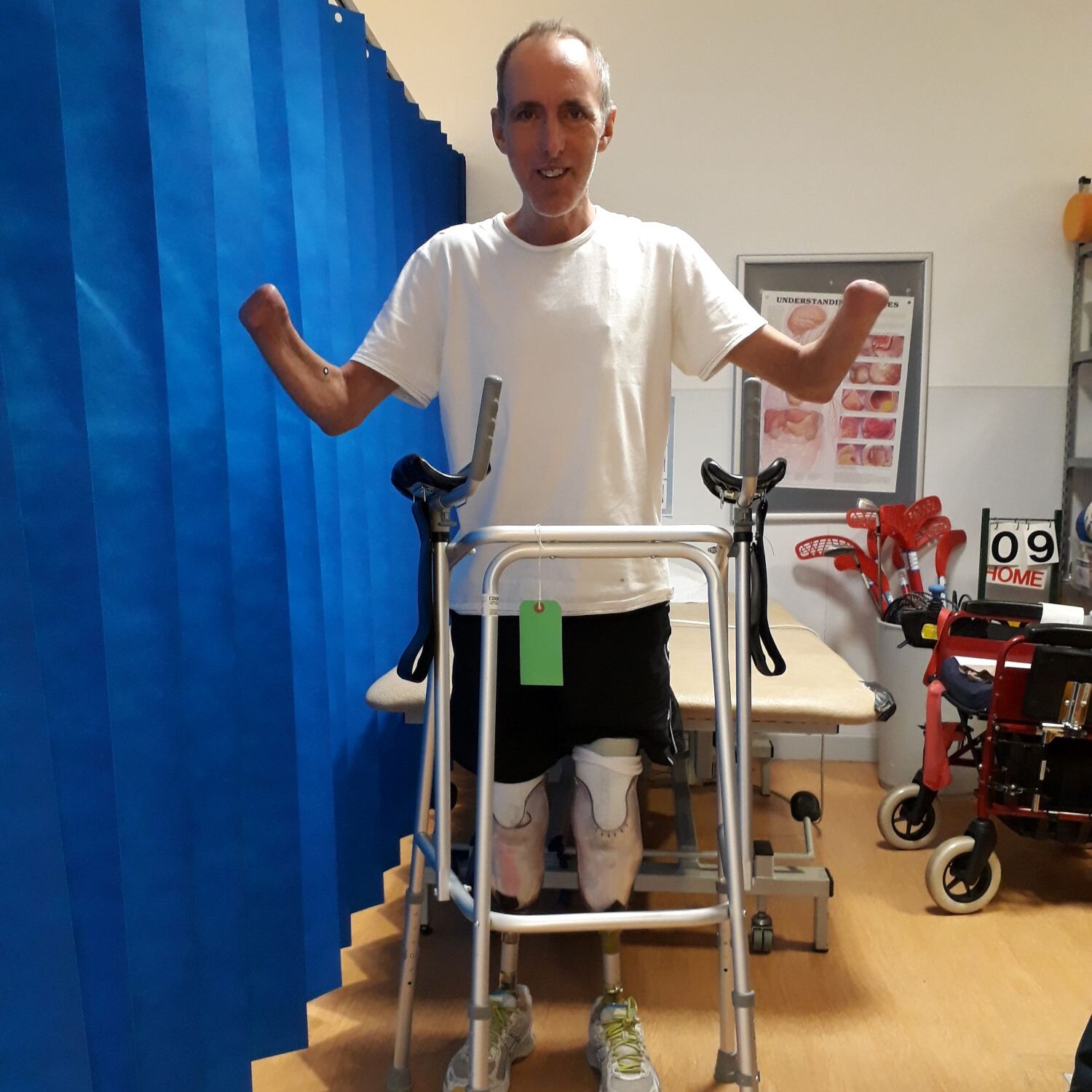 Mike Davies stood at a zimmer frame with prosthetic legs