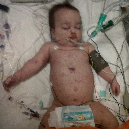 A photograph of baby Amelia in the hospital with a number of tubes attached to her and a rash over her body.