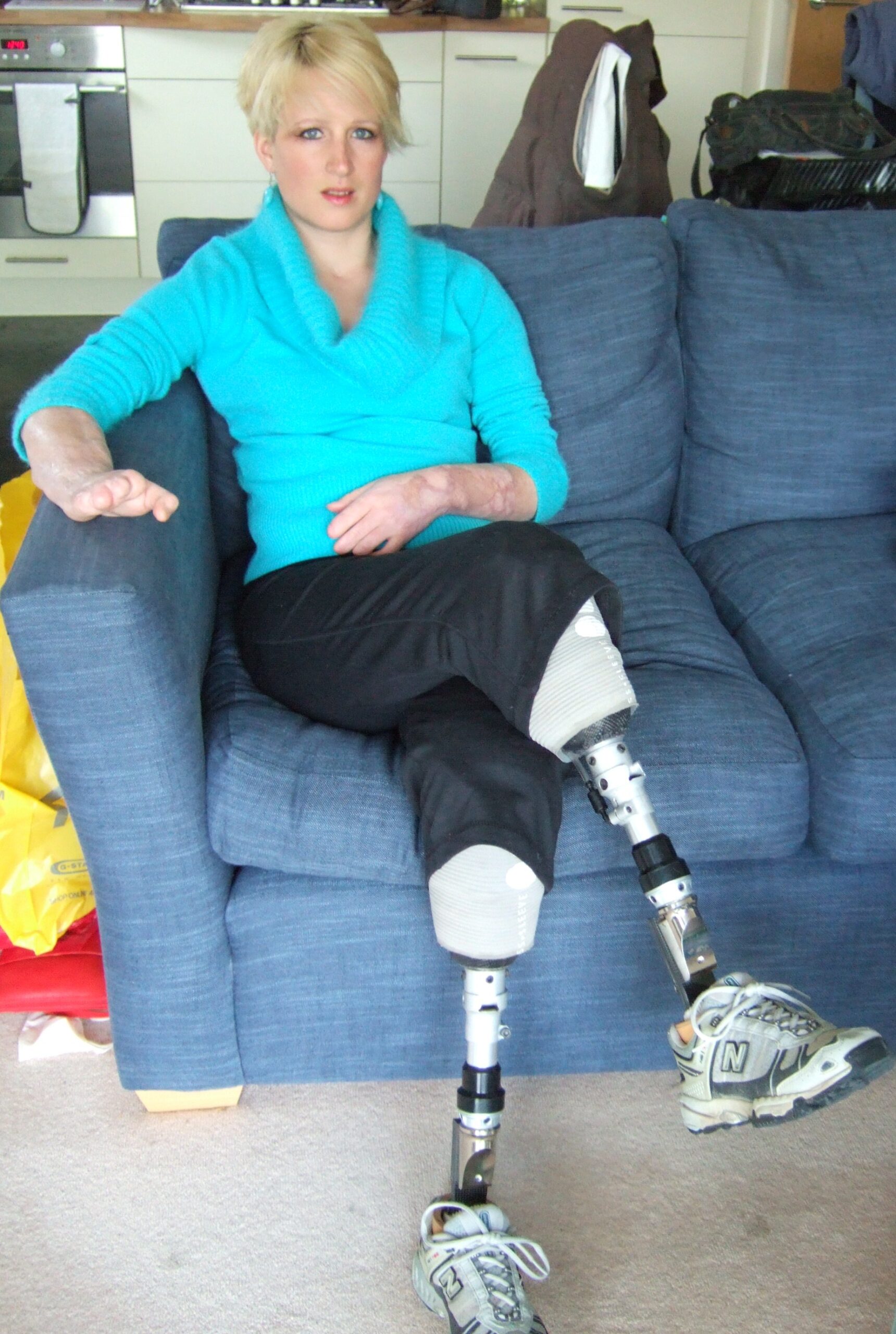 A photograph of Diana Man seated on a couch wearing prosthetic legs.