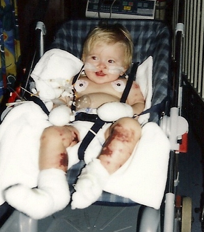 Ella Bailey as a baby covered in bandages and scarring