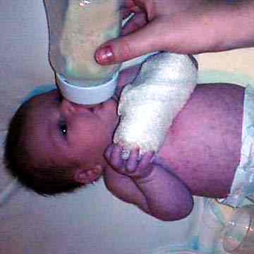 a photograph of baby Megan being fed a bottle with her arm in a bandage