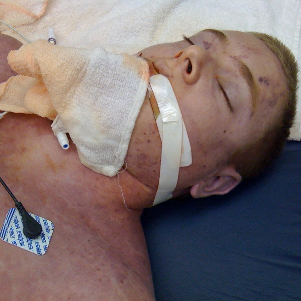 A photograph of Scotty in hospital with a breathing tube