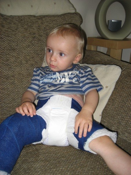 A photograph of baby Fraser Macintosh in a lower body cast.