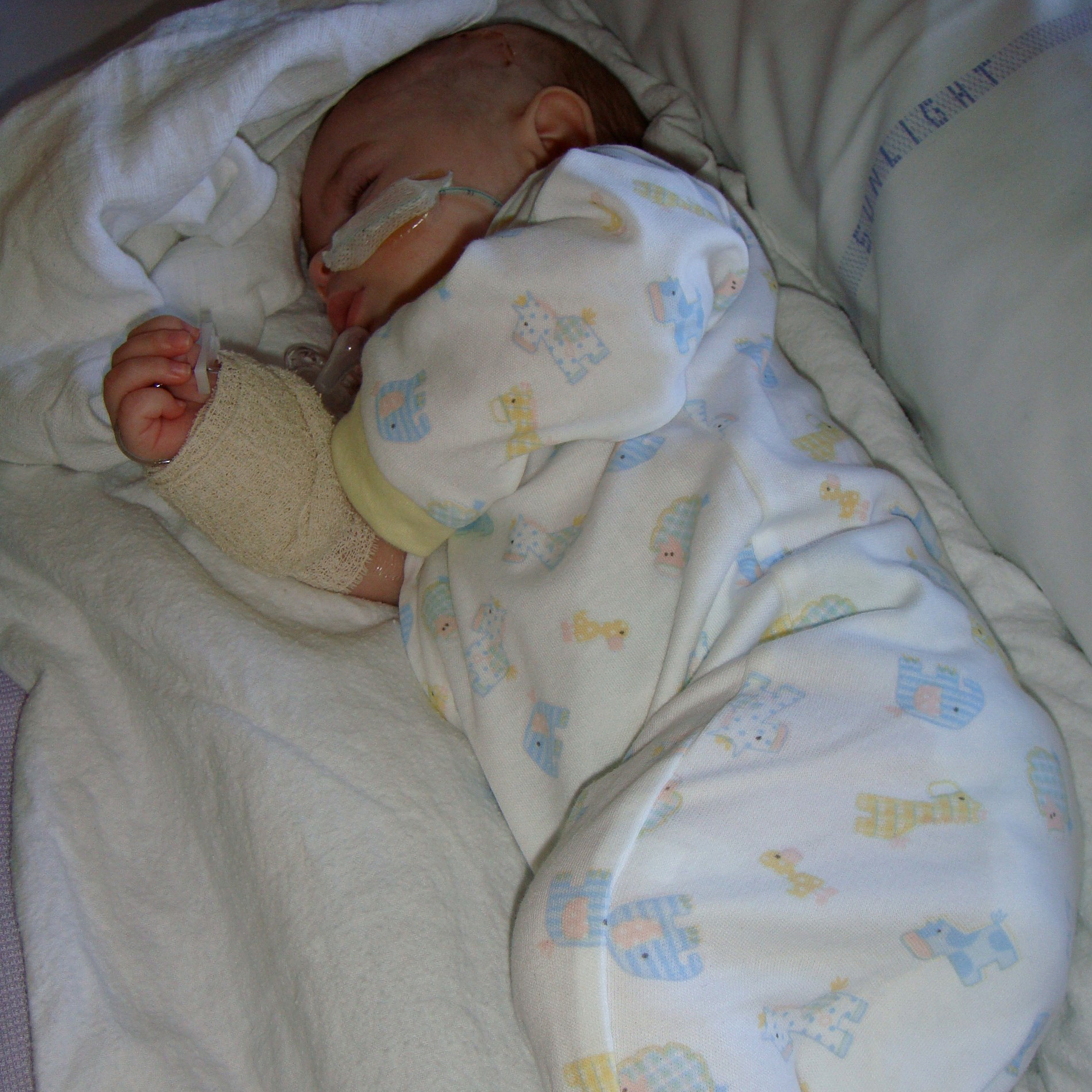A photograph of baby Luke in a hospital bed with a breathing tube