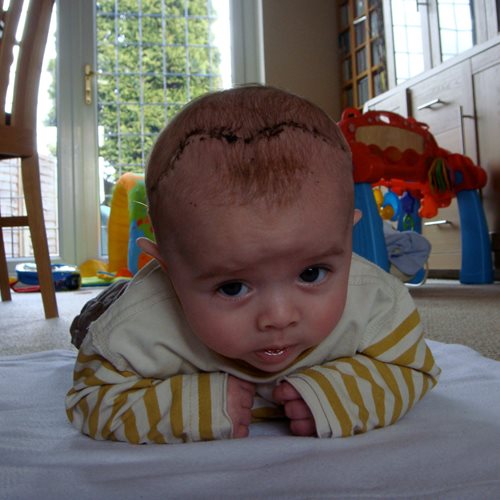 A photograph of baby Luke with an operation scar across his head.